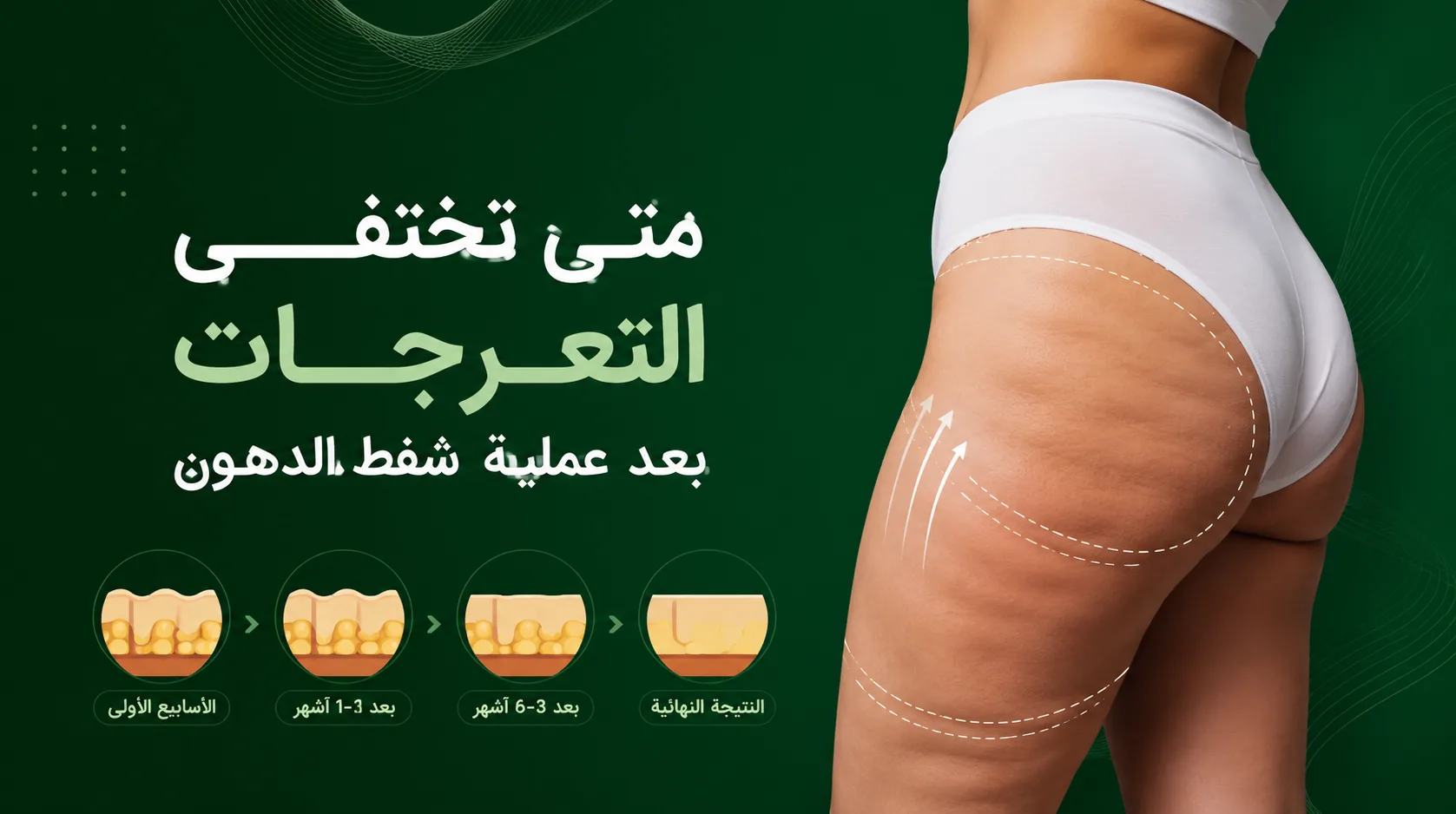 هل عدم انتظام الجلد بعد شفط الدهون أمر طبيعي؟